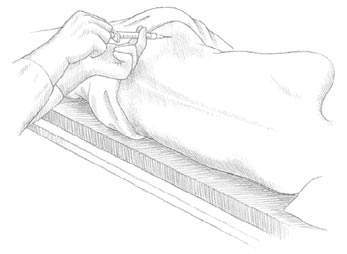 A sample of bone marrow is usually taken from the back of the hip bone